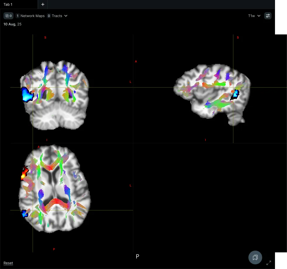 Three-pane VoxelBox viewer showing coronal, sagittal and axial slices with tractography and a functional network overlay linked by a shared crosshair.
